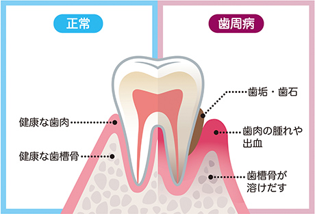 歯周病の治療、歯石除去、歯ブラシ指導